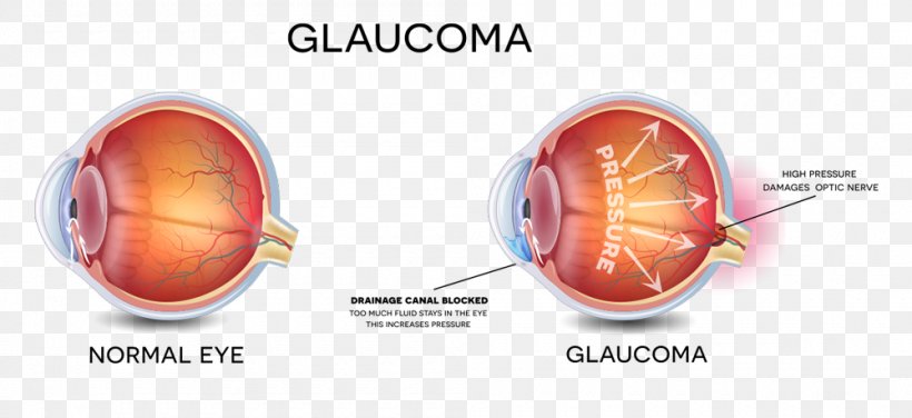 Glaucoma Vision Loss Eye Examination Eye Care Professional, PNG, 1000x459px, Glaucoma, Disease, Eye, Eye Care Professional, Eye Drops Lubricants Download Free