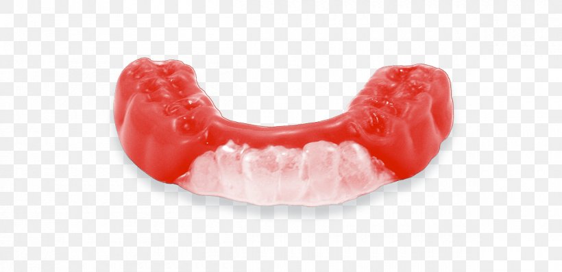 Mouthguard Tooth Athlete Sport Dentures, PNG, 1200x582px, Mouthguard, Athlete, Breathing, Concussion, Dentures Download Free