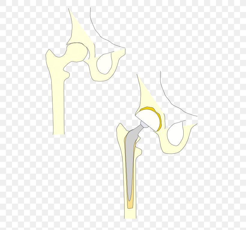 Hip Replacement Prosthesis Joint Pelvis, PNG, 578x768px, Watercolor, Cartoon, Flower, Frame, Heart Download Free
