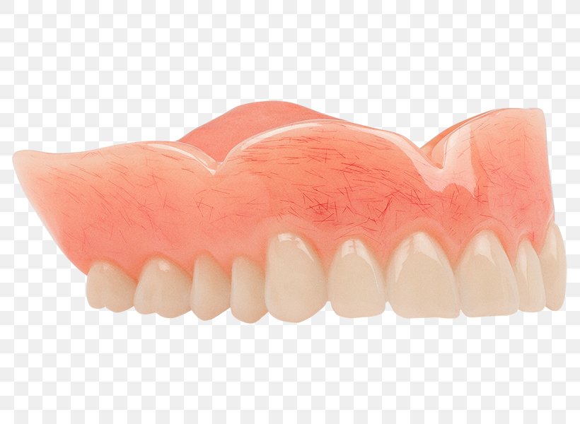 Dentures Tooth Dentistry Aspen Dental Acrylic Resin, PNG, 800x600px, Dentures, Acrylic Resin, Aspen Dental, Classic, Dentistry Download Free