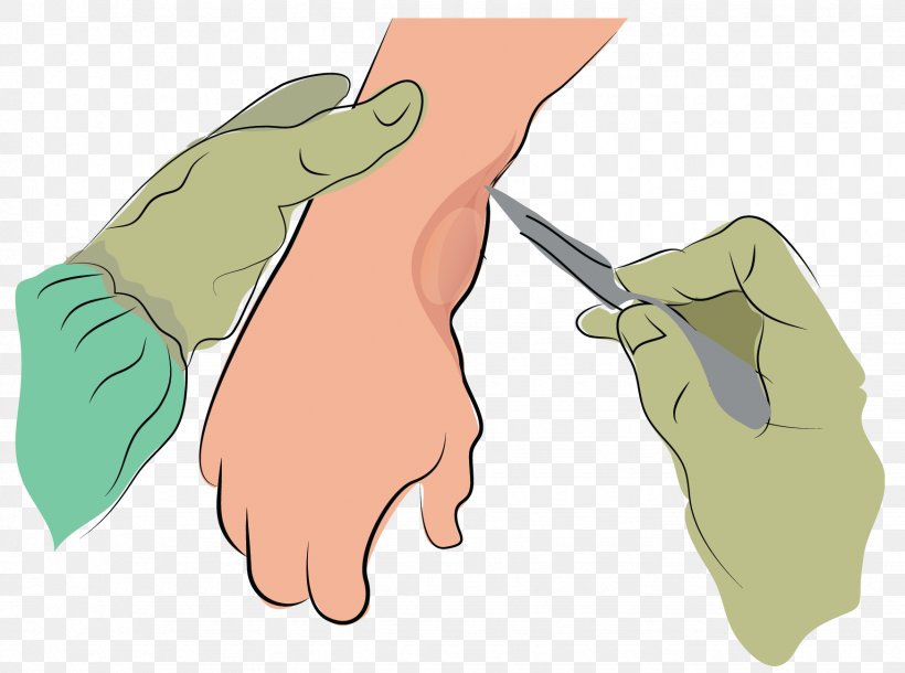 Synovial Cyst Finger Joint Synovial Fluid, PNG, 1746x1300px, Watercolor, Cartoon, Flower, Frame, Heart Download Free