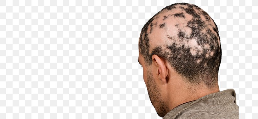 Alopecia Areata Non Scarring Hair Loss Pattern Hair Loss, PNG, 699x380px, Alopecia Areata, Autoimmune Disease, Chin, Dermatology, Disease Download Free