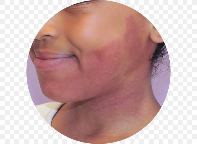 Arteriovenous Malformation Malformacja Birthmark Vascular Malformation Cheek, PNG, 600x600px, Arteriovenous Malformation, Birthmark, Bleeding, Capillary, Cheek Download Free