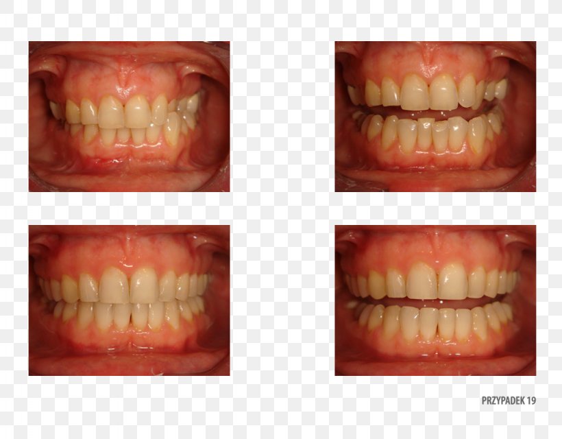 Tooth Therapy Patient Service Quality, PNG, 1024x800px, Tooth, Chin, Jaw, Lip, Mouth Download Free