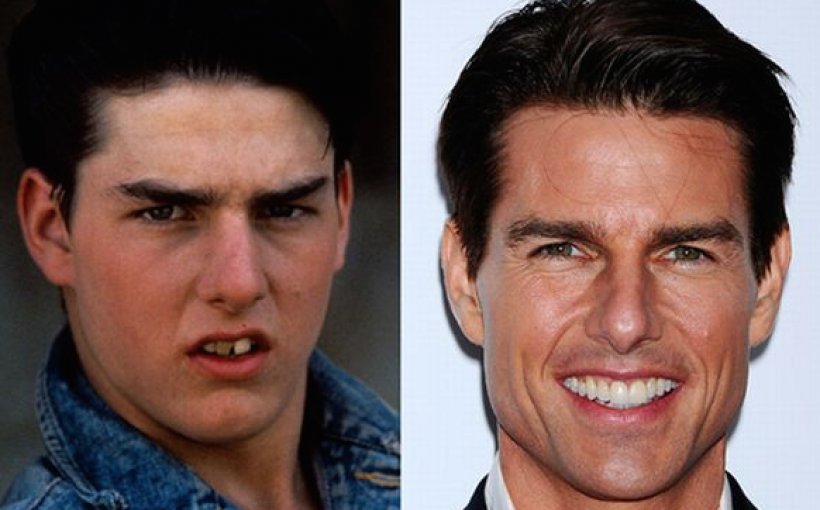 Tom Cruise Teeth Celebrity Dentistry Veneer, PNG, 1164x724px, Tom Cruise, Celebrity, Cheek, Chin, Cosmetic Dentistry Download Free