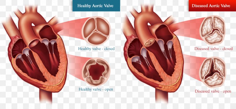 Valvular Aortic Stenosis Aortic Valve Replacement Heart Valve Disease Balloon Valvuloplasty, PNG, 1071x497px, Watercolor, Cartoon, Flower, Frame, Heart Download Free