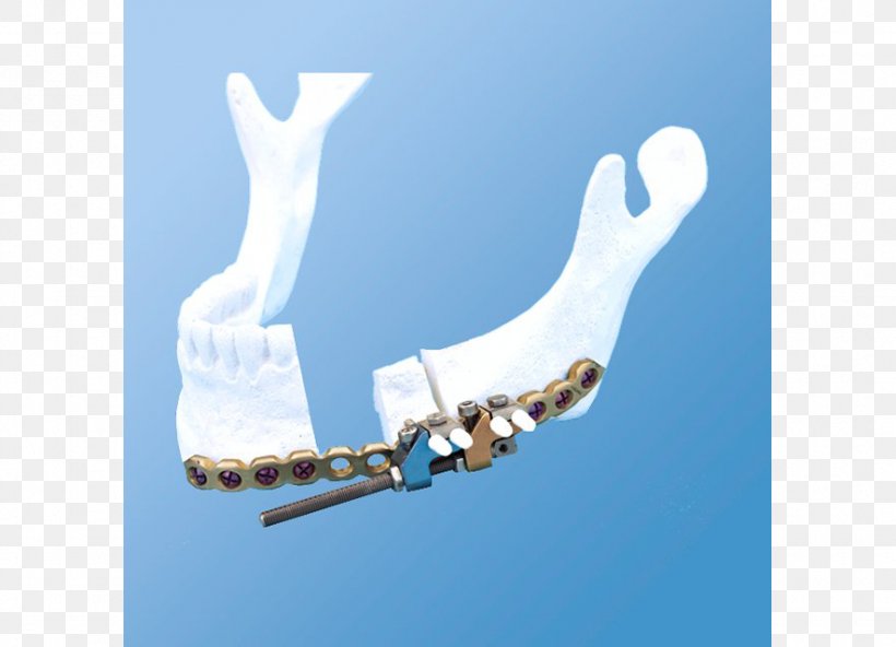 Mandible Distraction Osteogenesis Bone DePuy Synthes Companies, PNG, 885x640px, Mandible, Bone, Condyloid Process, Depuy Synthes Companies, Distraction Osteogenesis Download Free