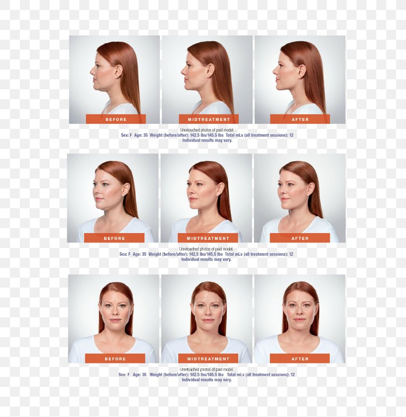 Deoxycholic Acid Face Surgery Chin Submental Triangle, PNG, 650x841px, Deoxycholic Acid, Baqbaqa, Brown Hair, Chin, Dermatology Download Free