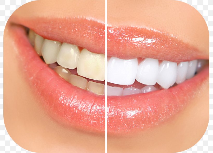 Tooth Whitening Dentistry Human Tooth, PNG, 793x588px, Tooth Whitening, Bad Breath, Cosmetic Dentistry, Crest Whitestrips, Dental Floss Download Free