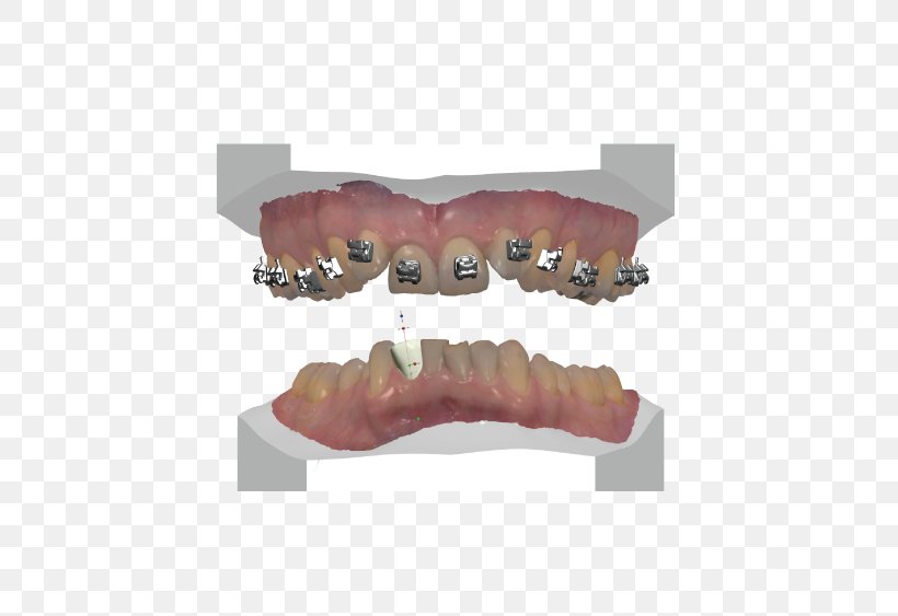 Tooth Dentures Prosthesis Computer-aided Design Computer Software, PNG, 640x563px, 3d Scanner, Tooth, Computer Appliance, Computer Software, Computeraided Design Download Free