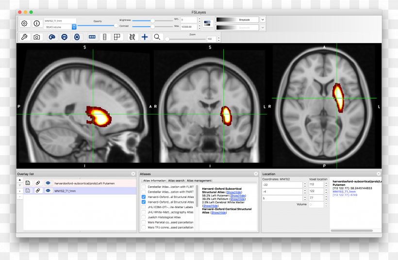 Brain Computed Tomography Neuroimaging, PNG, 2816x1844px, Watercolor, Cartoon, Flower, Frame, Heart Download Free