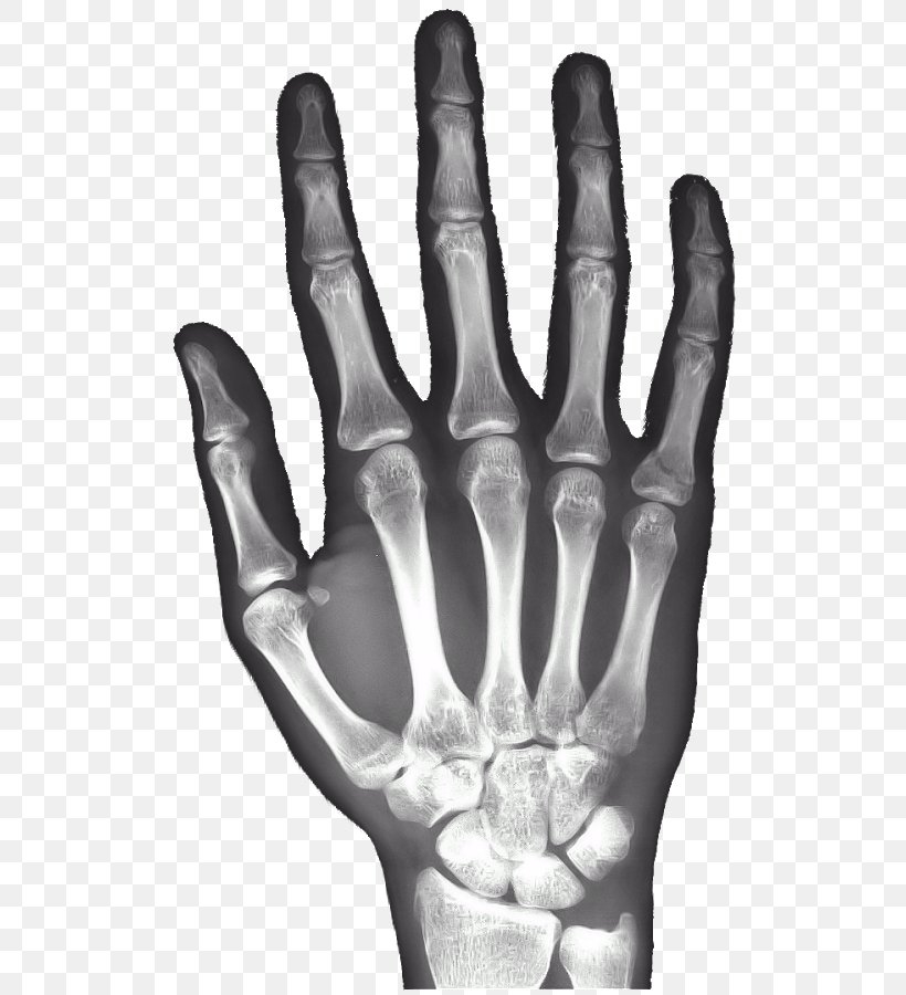 X-ray Hand Carpal Bones Android, PNG, 523x900px, Xray, Android, Black And White, Bone, Bone Age Download Free