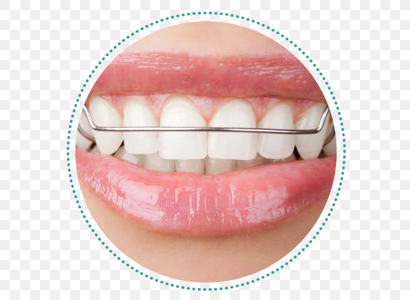 Orthodontics Dental Braces Dentistry Retainer Bridge, PNG, 600x600px, Orthodontics, Bridge, Clear Aligners, Cosmetic Dentistry, Crown Download Free