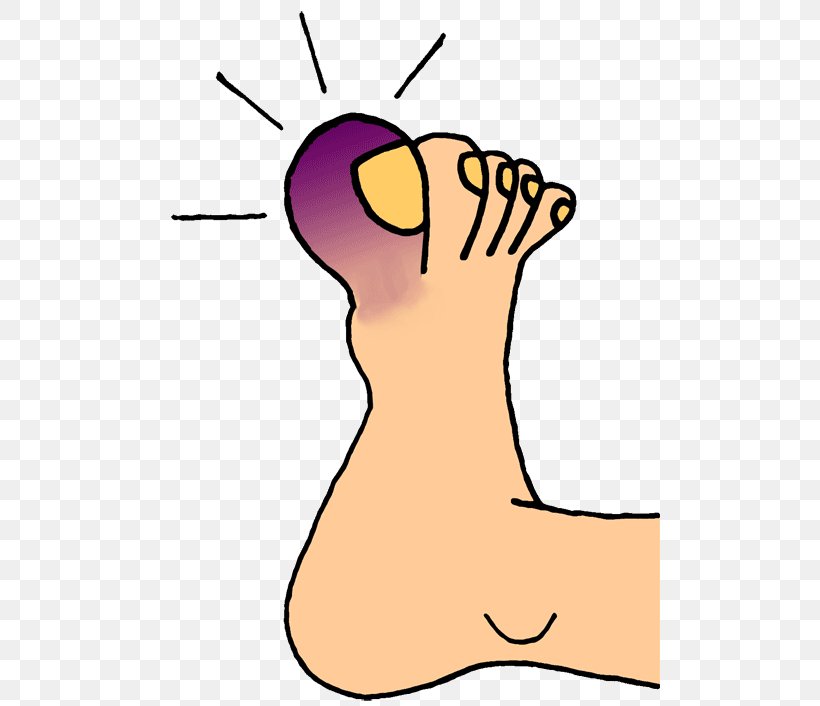 Toe Nail Foot Onychocryptosis Clip Art, PNG, 500x706px, Watercolor, Cartoon, Flower, Frame, Heart Download Free