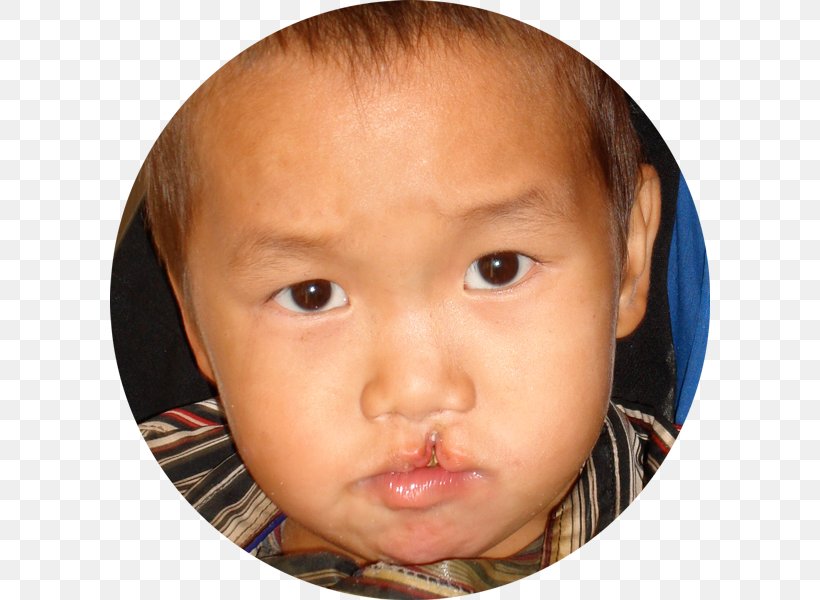 Cleft Lip And Cleft Palate Craniofacial Surgery, PNG, 600x600px, Lip, Birth Defect, Cheek, Child, Chin Download Free