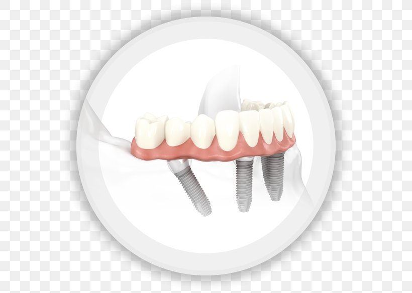 All-on-4 Dental Implant Dentistry Edentulism, PNG, 584x584px, Dental Implant, Bridge, Dental Surgery, Dental Tourism, Dentist Download Free