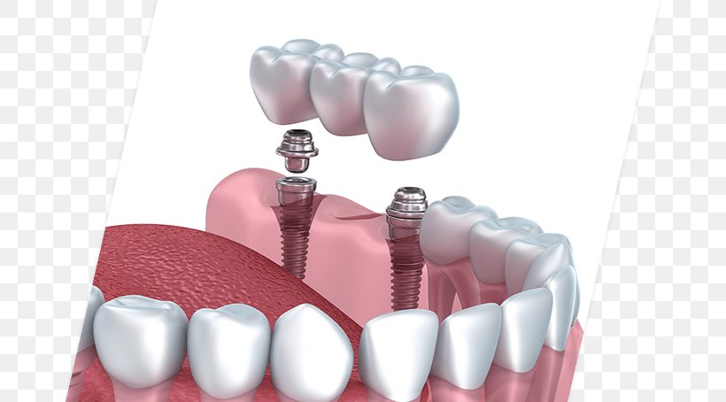 Dental Implant Cosmetic Dentistry Bridge, PNG, 681x454px, Watercolor, Cartoon, Flower, Frame, Heart Download Free