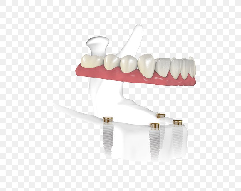 Tooth Dental Implant Dentist Edentulism, PNG, 650x650px, Tooth, Aesthetics, Dental Implant, Dentist, Edentulism Download Free