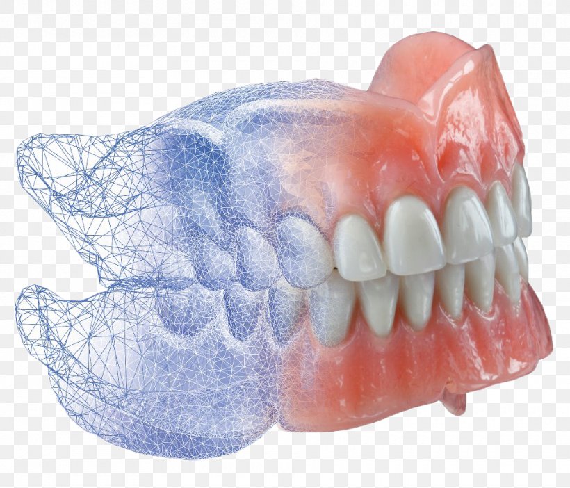 AvaDent Dentures CAD/CAM Dentistry, PNG, 960x822px, Avadent, Burdette Dental Lab, Cadcam Dentistry, Cosmetic Dentistry, Dental Implant Download Free