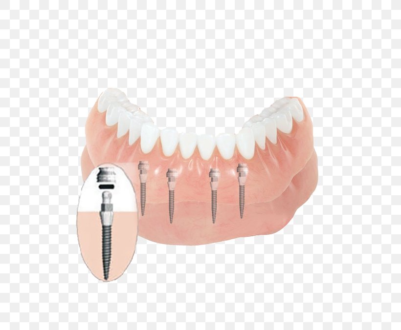 Tooth Dentures Dental Implant Dentistry, PNG, 650x676px, Tooth, Bridge, Clinic, Cosmetic Dentistry, Dental Braces Download Free