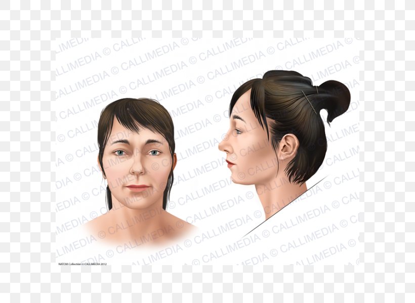 Face Acromegaly Skull Bossing Symptom Gigantism Png Image Pnghero The