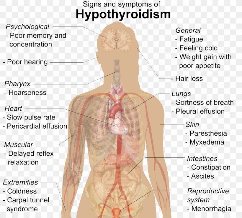 Hypothyroidism Thyroid Disease Medical Sign Levothyroxine, PNG, 1024x926px, Watercolor, Cartoon, Flower, Frame, Heart Download Free