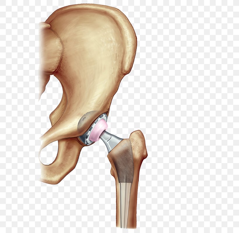 Hip Replacement Surgery Knee Replacement Joint Replacement, PNG, 600x800px, Hip Replacement, Ache, Arm, Arthritis, Bone Download Free