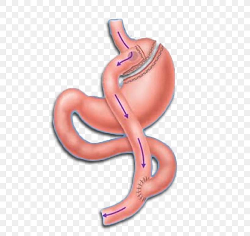 Roux-en-Y Anastomosis Gastric Bypass Surgery Bariatric Surgery Sleeve Gastrectomy, PNG, 700x773px, Watercolor, Cartoon, Flower, Frame, Heart Download Free