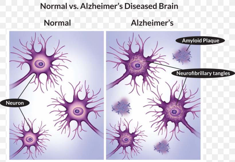 Alzheimer's Disease Stock Photography Health Medicine, PNG, 1200x830px, Alzheimers Disease, Dementia, Disease, Health, Medicine Download Free