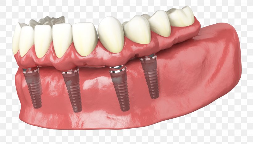 Tooth Dental Implant Dentures Dentistry, PNG, 2220x1266px, Tooth, Bridge, Dental Implant, Dentist, Dentistry Download Free