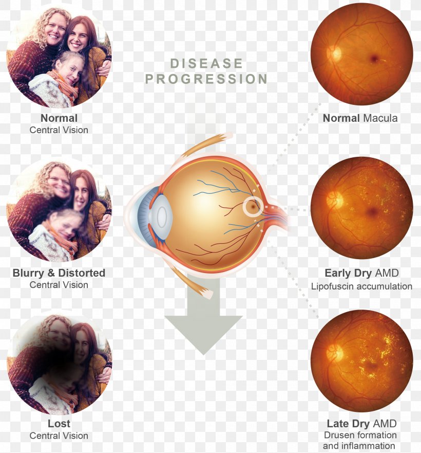Macular Degeneration Macula Of Retina Stargardt Disease, PNG, 2000x2150px, Macular Degeneration, Blindness, Cornea, Degeneration, Diabetic Retinopathy Download Free
