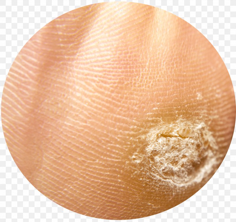 Callus Plantar Wart Foot Sole, PNG, 2221x2091px, Callus, Ball, Bunion, Corn, Dermatology Download Free