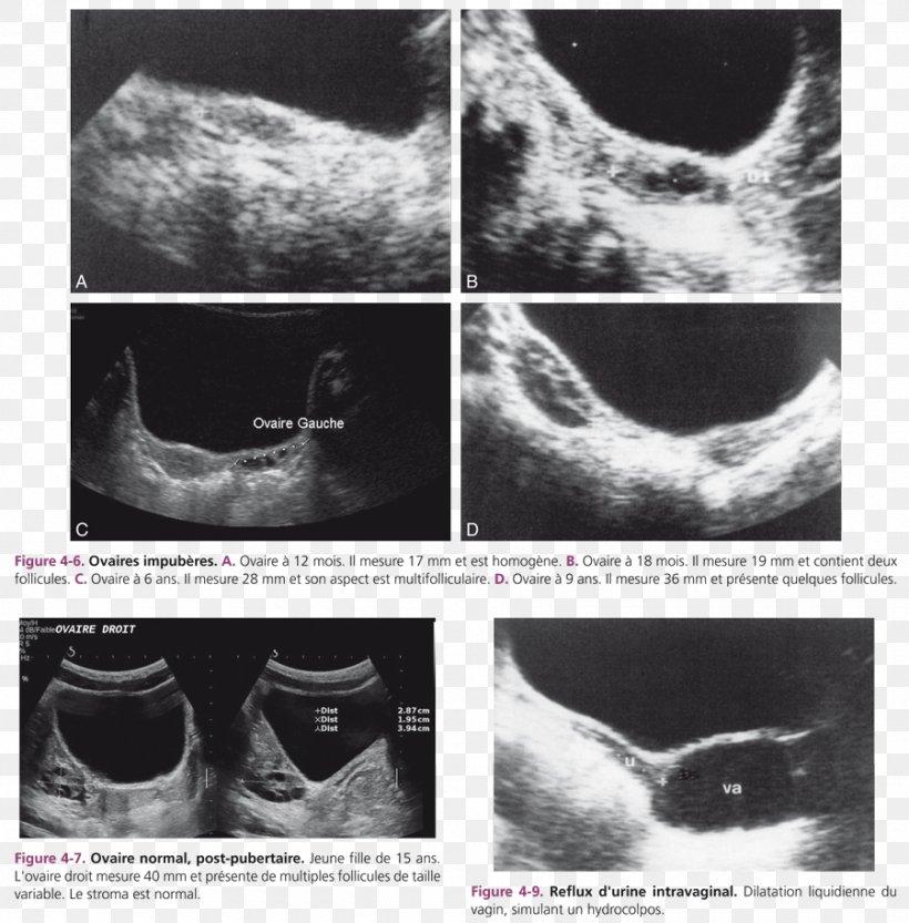 Ovary Gynecologic Ultrasonography Ovarian Follicle Ovarian Cyst, PNG, 900x915px, Ovary, Abdominal Ultrasonography, Black And White, Cyst, Endometriosis Download Free