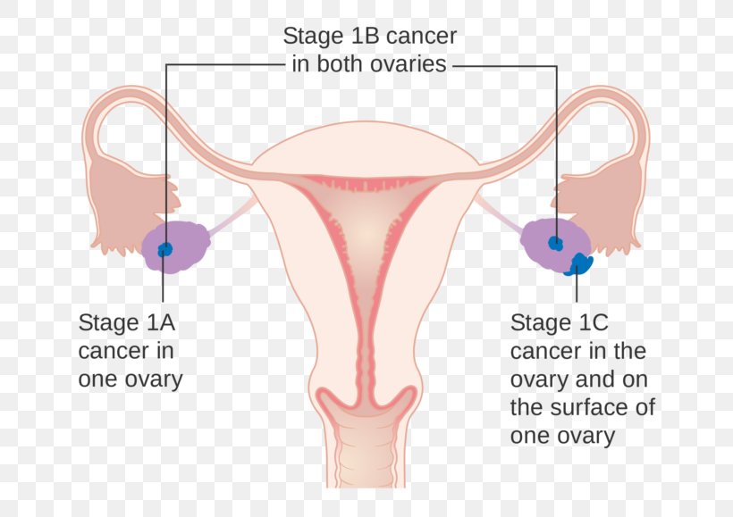 Ovarian Cancer Cancer Staging Ovary Cancer Research UK, PNG, 700x579px, Watercolor, Cartoon, Flower, Frame, Heart Download Free