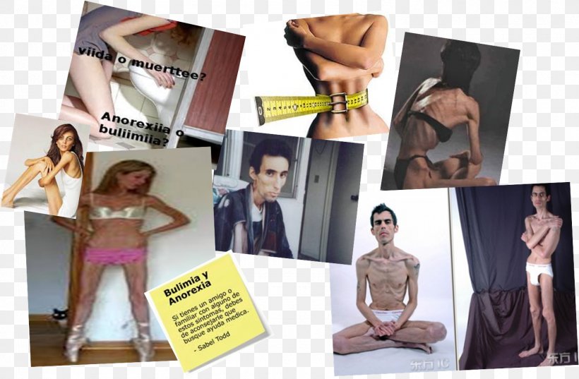 Anorexia Nervosa Bulimia Nervosa Disease Symptom, PNG, 1479x970px, Anorexia, Advertising, Anorexia Nervosa, Brand, Bulimia Nervosa Download Free