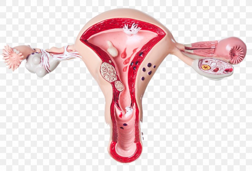 Ovary Ovarian Cyst Pain Uterus Symptom, PNG, 1526x1042px, Ovary, Cyst, Fallopian Tube, Female, Gynaecology Download Free