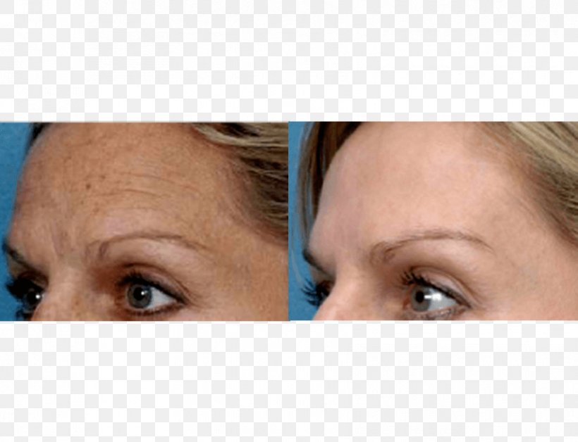 Photorejuvenation Facial Rejuvenation Collagen Induction Therapy Skin, PNG, 854x655px, Photorejuvenation, Cheek, Chin, Close Up, Collagen Induction Therapy Download Free