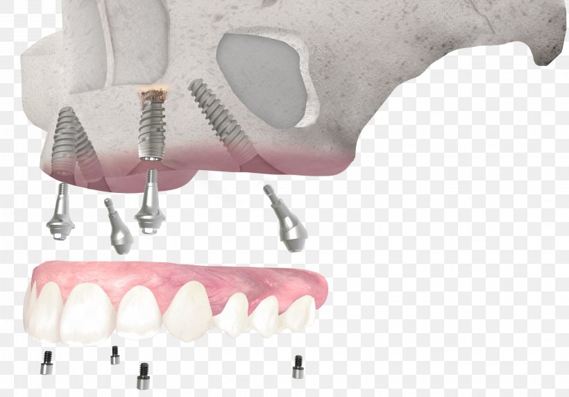 Tooth Dental Implant Dentistry All-on-4, PNG, 3094x2160px, Tooth, Bone, Cosmetic Dentistry, Dental Implant, Dental Restoration Download Free
