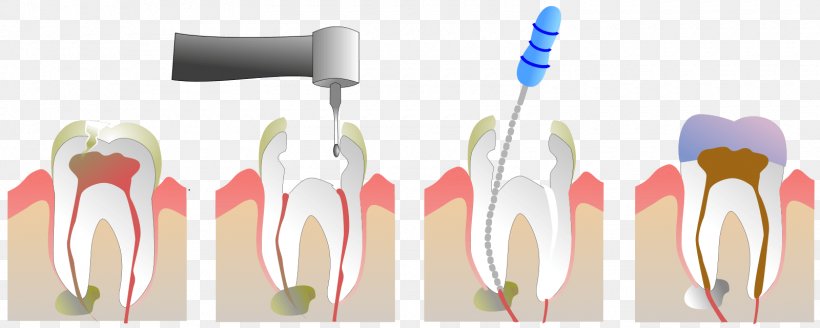 Endodontic Therapy Pulp Root Canal Dentistry, PNG, 1600x640px, Endodontic Therapy, Brush, Cutlery, Dental Abscess, Dental Surgery Download Free