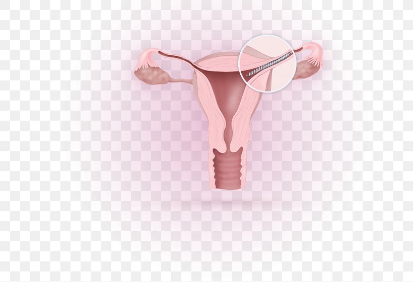 Essure Birth Control Fallopian Tube Sterilization Tubal Ligation, PNG, 663x561px, Essure, Birth Control, Fallopian Tube, Food And Drug Administration, Hysteroscopy Download Free