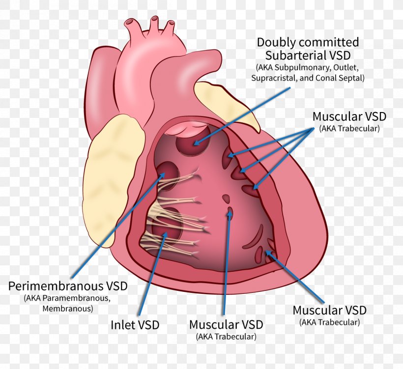 Heart Ventricular Septal Defect Interventricular Septum Ventricle, PNG, 1200x1100px, Watercolor, Cartoon, Flower, Frame, Heart Download Free