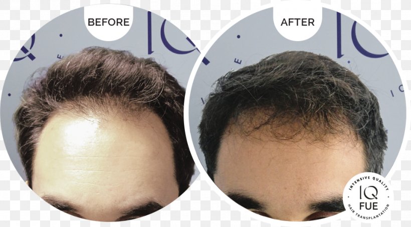 Hair Transplantation Hair Loss Hamilton–Norwood Scale Follicular Unit Extraction, PNG, 958x530px, Hair Transplantation, Chin, Ear, Eyelash, Follicular Unit Extraction Download Free