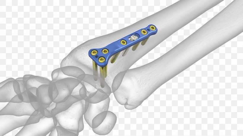 Lunate Bone Distal Radius Fracture Radial Styloid Process, PNG, 4000x2250px, Lunate Bone, Bone, Bone Fracture, Distal, Distal Radius Fracture Download Free