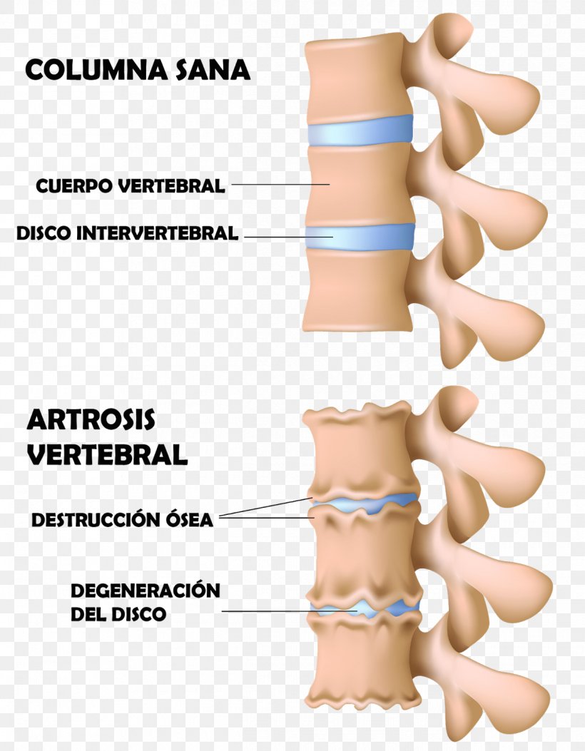 Vertebral Column Osteophyte Osteoarthritis Bone Degenerative Disc Disease, PNG, 1245x1600px, Watercolor, Cartoon, Flower, Frame, Heart Download Free