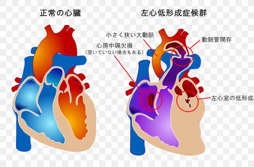 Tetralogy Of Fallot Congenital Heart Defect Blue Baby Syndrome Pentalogy Of Fallot, PNG, 1200x793px, Watercolor, Cartoon, Flower, Frame, Heart Download Free