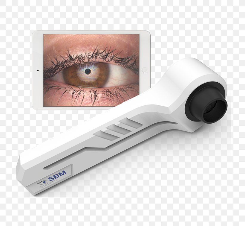 Dry Eye Syndrome Ophthalmology Disease Meibomian Gland, PNG, 726x755px, Dry Eye Syndrome, Disease, Dry Eye, Eye, Eyelash Download Free