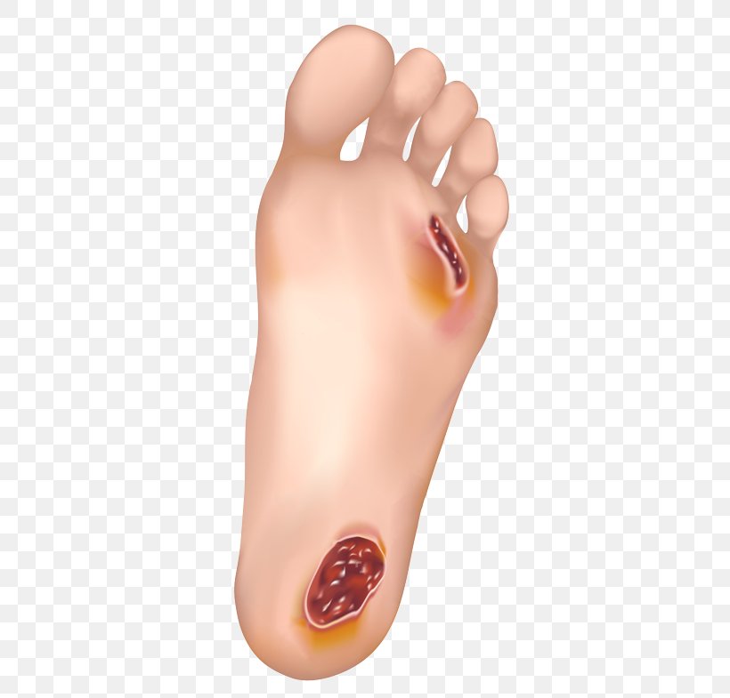 Diabetic Foot Ulcer Diabetes Mellitus Disease Podiatrist, PNG, 480x785px, Watercolor, Cartoon, Flower, Frame, Heart Download Free
