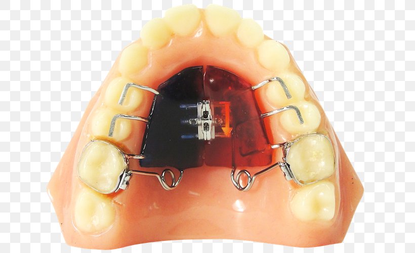 ROA, PNG, 639x500px, Roa Ricoh Orthodontic Appliances, Dental Braces, Dentistry, Dentition, Distal Download Free