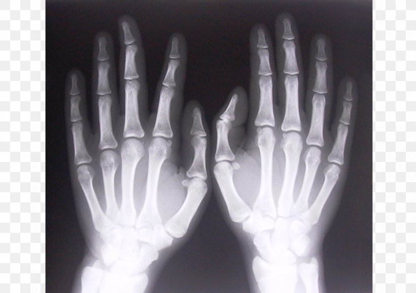 Backscatter X-ray Rheumatoid Arthritis Joint, PNG, 842x595px, Xray, Arthritis, Backscatter Xray, Black And White, Bone Download Free