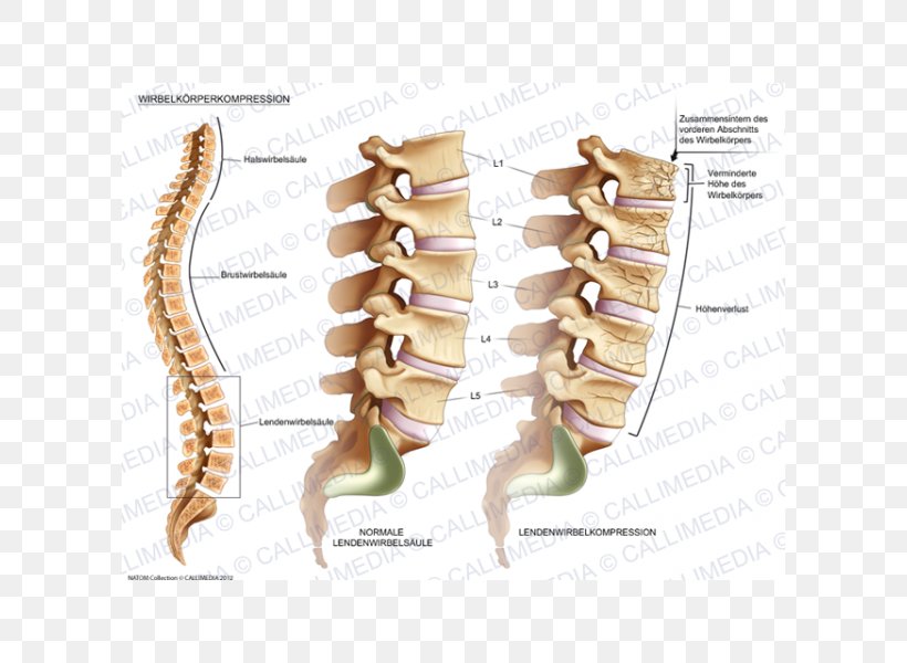 Vertebral Compression Fracture Vertebral Column Lumbar Vertebrae Bone Fracture, PNG, 600x600px, Watercolor, Cartoon, Flower, Frame, Heart Download Free